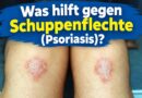 Was hilft gegen Schuppenflechte