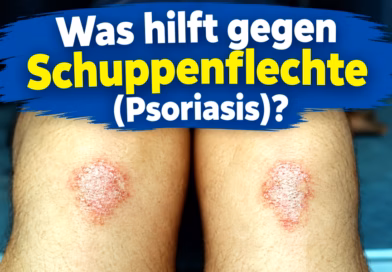 Was hilft gegen Schuppenflechte