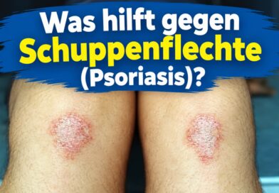 Was hilft gegen Schuppenflechte
