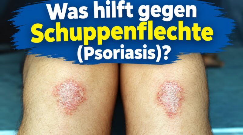 Was hilft gegen Schuppenflechte